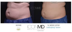coolsculpting before after abdomen
