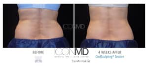 coolsculpting before after back