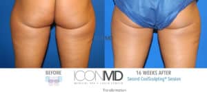 coolsculpting before after thighs