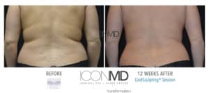 coolsculpting before after back