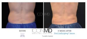 coolsculpting before after back