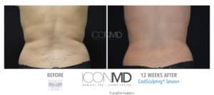coolsculpting before after back