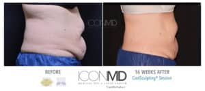 coolsculpting before after abdomen