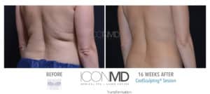 coolsculpting before after back