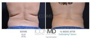 coolsculpting before after back