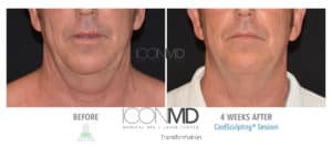 coolsculpting before after neck