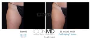 coolsculpting before after thighs