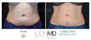 coolsculpting before after abdomen