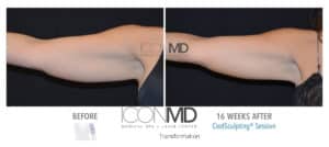 coolsculpting before after arms