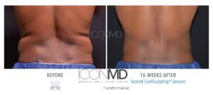 coolsculpting before after back