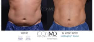 coolsculpting before after abdomen