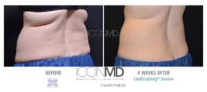 coolsculpting before after abdomen