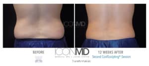 coolsculpting before after back