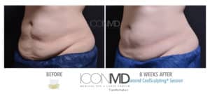 coolsculpting before after abdomen