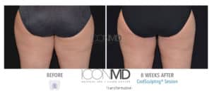 coolsculpting before after thighs