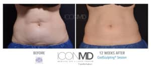 coolsculpting before after abdomen