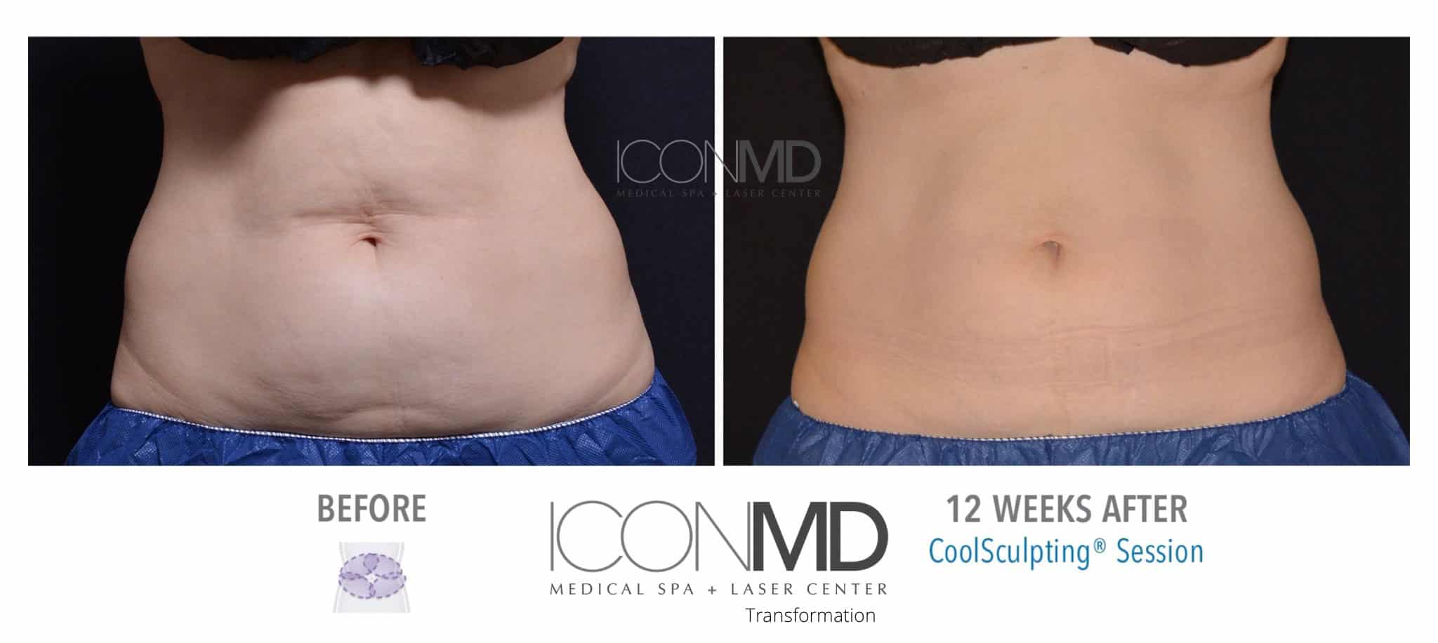 50% Off CoolSculpting Boca Raton | Icon MD