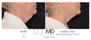 coolsculpting before after neck
