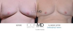 coolsculpting before after chest