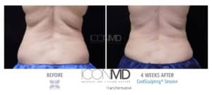coolsculpting before after back