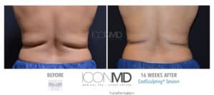 coolsculpting before after back