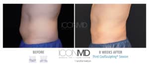 coolsculpting before after abdomen