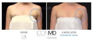 coolsculpting before after arms