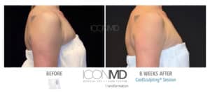 coolsculpting before after arms