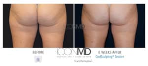 coolsculpting before after thighs