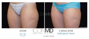 coolsculpting before after thighs