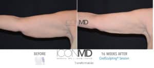 coolsculpting before after arms