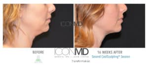 coolsculpting before after neck