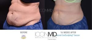 coolsculpting before after abdomen