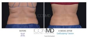 coolsculpting before after back