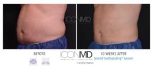 coolsculpting before after abdomen