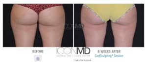 coolsculpting before after thighs