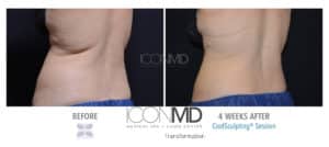 coolsculpting before after back
