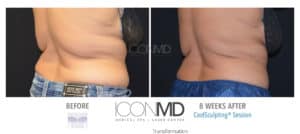coolsculpting before after back