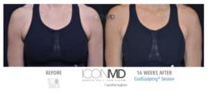 B421E2DF-coolsculpting-before-after-arms