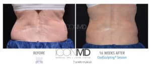 coolsculpting before after back