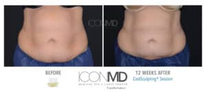 coolsculpting before after abdomen