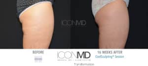 coolsculpting before after thighs