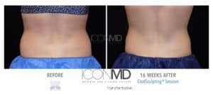 coolsculpting before after back