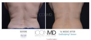 coolsculpting before after back