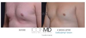 coolsculpting before after chest