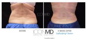 coolsculpting before after back