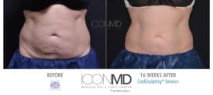 coolsculpting before after abdomen