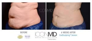 coolsculpting before after abdomen