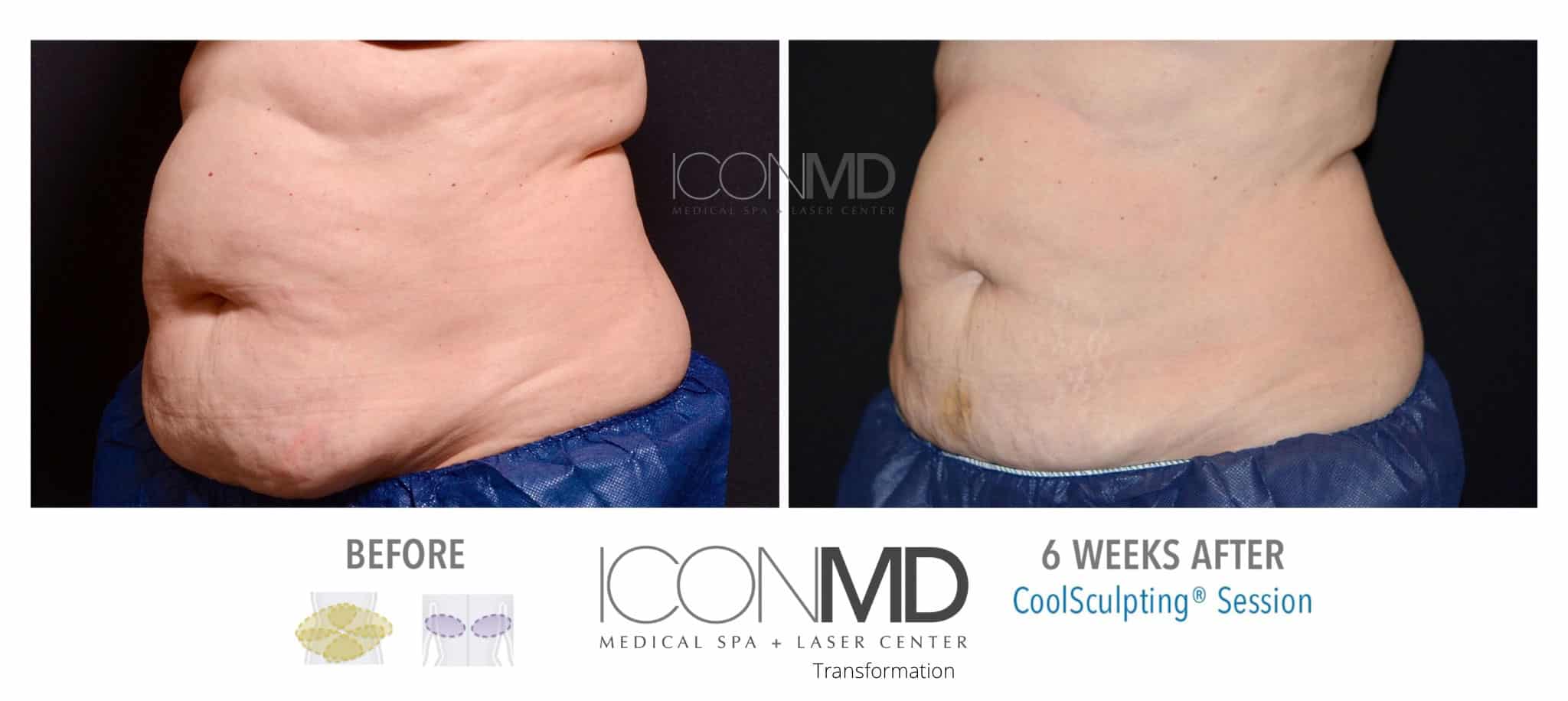 50% Off CoolSculpting Boca Raton | Icon MD