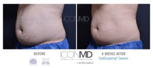 coolsculpting before after abdomen